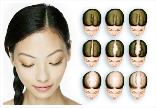Диффузное выпадение волос у женщин - узнай что это такое и причины